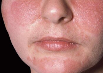 La “mascné” et les problèmes de peau liés au port du masque