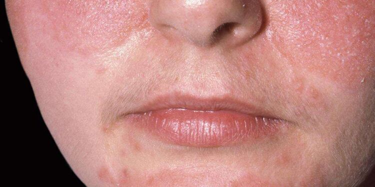 La “mascné” et les problèmes de peau liés au port du masque 2 - Le Progrès Egyptien La “mascné” et les problèmes de peau liés au port du masque 1 - Le Progrès Egyptien