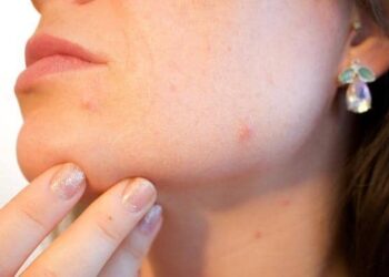 Comment avoir une peau sans acné ?