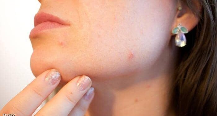 Comment avoir une peau sans acné ? 1 - Le Progrès Egyptien