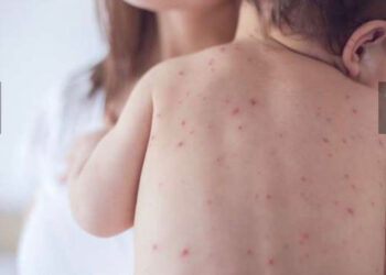 L’agence de santé américaine craint un retour de la rougeole