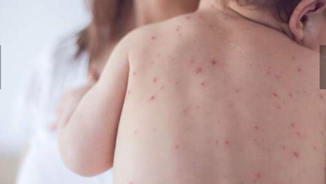 L’agence de santé américaine craint un retour de la rougeole 1 - Le Progrès Egyptien