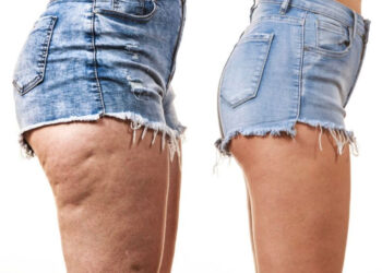 Cellulite : 6 gestes à adopter pour s’en débarrasser