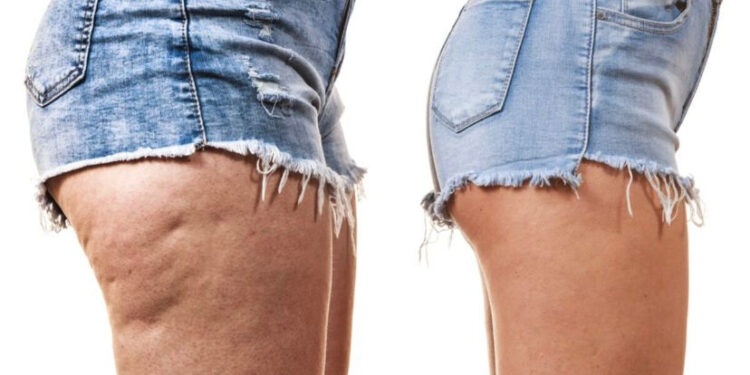 Cellulite : 6 gestes à adopter pour s’en débarrasser 1 - Le Progrès Egyptien