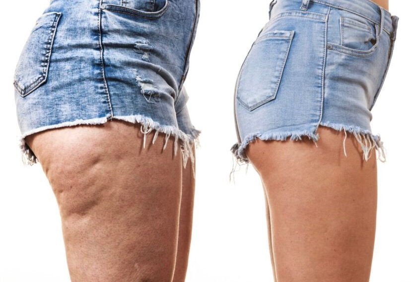 Cellulite : 6 gestes à adopter pour s’en débarrasser 1 - Le Progrès Egyptien
