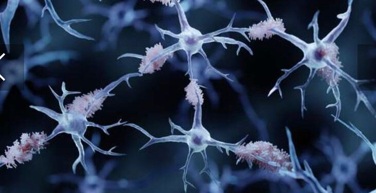 Maladie d’Alzheimer : 75 facteurs de risques génétiques ont été identifiés 2 - Le Progrès Egyptien Maladie d’Alzheimer : 75 facteurs de risques génétiques ont été identifiés 1 - Le Progrès Egyptien