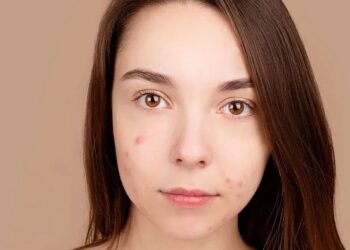 Pour éviter l’acné, mangez ces aliments