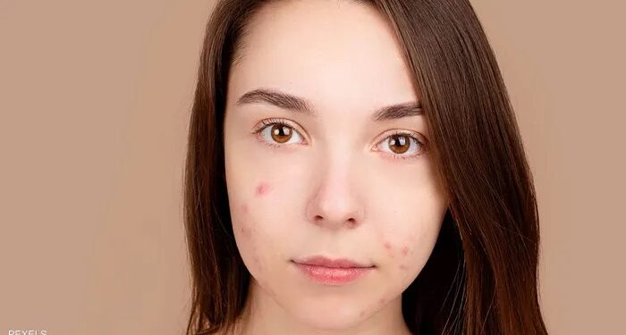 Pour éviter l’acné, mangez ces aliments 1 - Le Progrès Egyptien