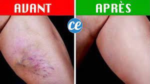 Les mesures suivantes peuvent aider à éviter l’apparition de varices