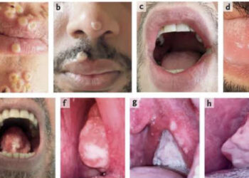 Variole du singe : Une grande variété de lésions cutanées
