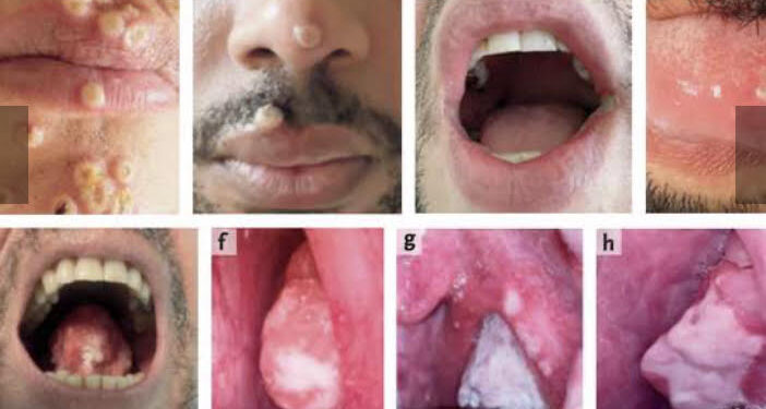 Variole du singe : Une grande variété de lésions cutanées 1 - Le Progrès Egyptien