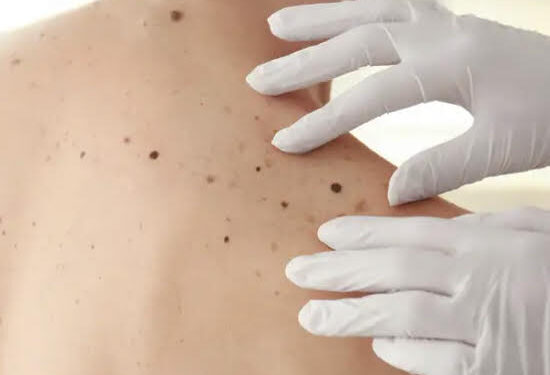 Bientôt un vaccin à ARN contre le cancer de la peau ? 2 - Le Progrès Egyptien Bientôt un vaccin à ARN contre le cancer de la peau ? 1 - Le Progrès Egyptien