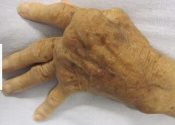 Des bactéries buccales à l’origine de la maladie auto-immune ?