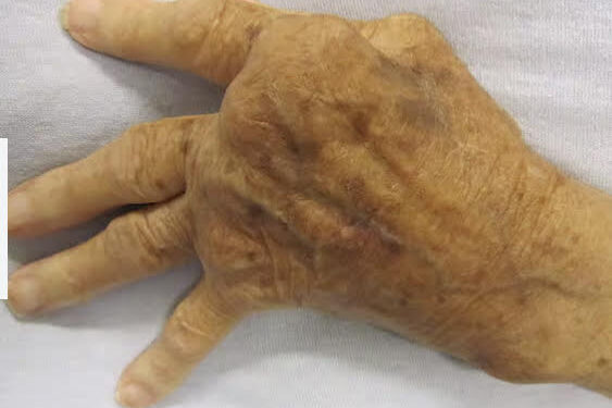 Des bactéries buccales à l’origine de la maladie auto-immune ? 2 - Le Progrès Egyptien Des bactéries buccales à l’origine de la maladie auto-immune ? 1 - Le Progrès Egyptien