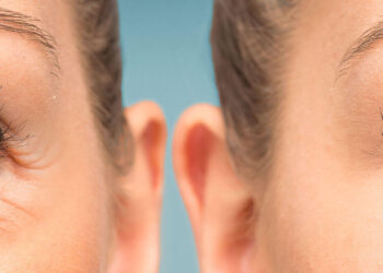 8 astuces pour lutter contre les yeux gonflés