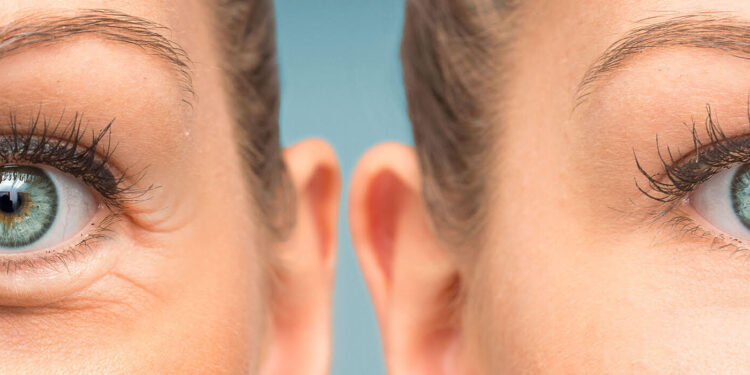 8 astuces pour lutter contre les yeux gonflés 1 - Le Progrès Egyptien