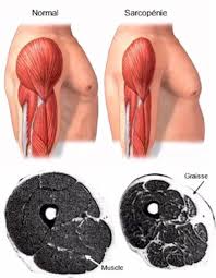 La sarcopénie : Le nouveau mal du siècle ? 5 - Le Progrès Egyptien