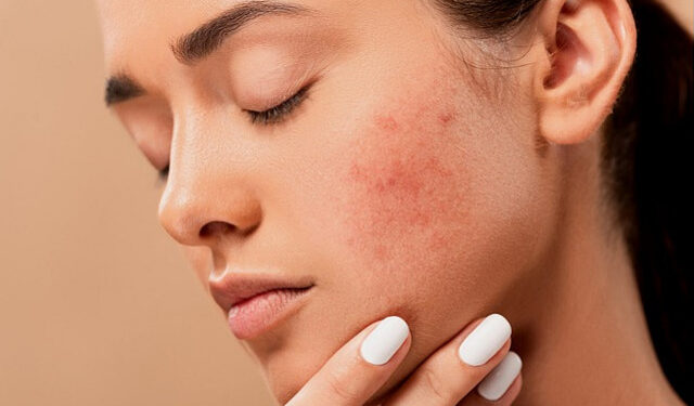 Boutons : Comment limiter ? 1 - Le Progrès Egyptien