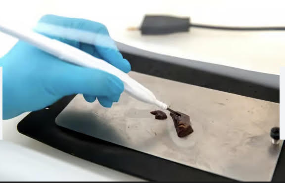 Le iknife pour détecter les cancers en quelques secondes 2 - Le Progrès Egyptien Le iknife pour détecter les cancers en quelques secondes 1 - Le Progrès Egyptien