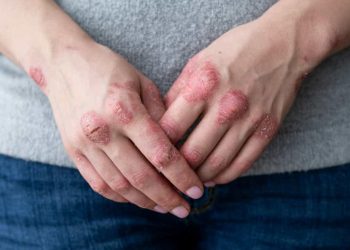 La sévérité du psoriasis pourrait être liée à une carence en vitamine D