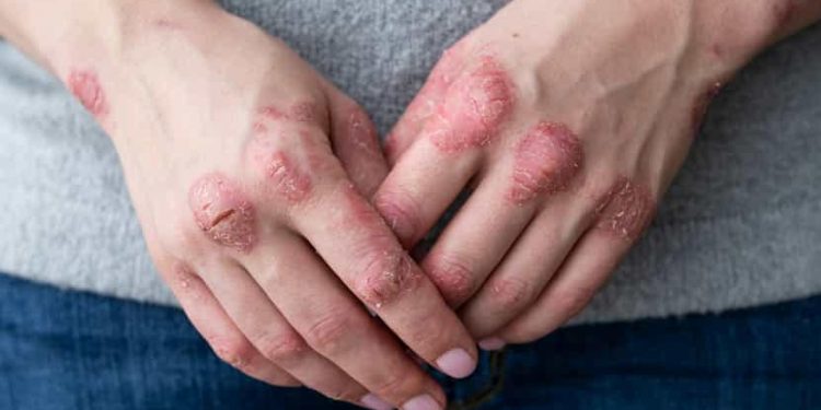 La sévérité du psoriasis pourrait être liée à une carence en vitamine D 1 - Le Progrès Egyptien