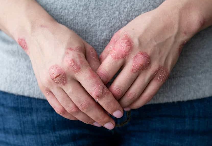 La sévérité du psoriasis pourrait être liée à une carence en vitamine D 1 - Le Progrès Egyptien