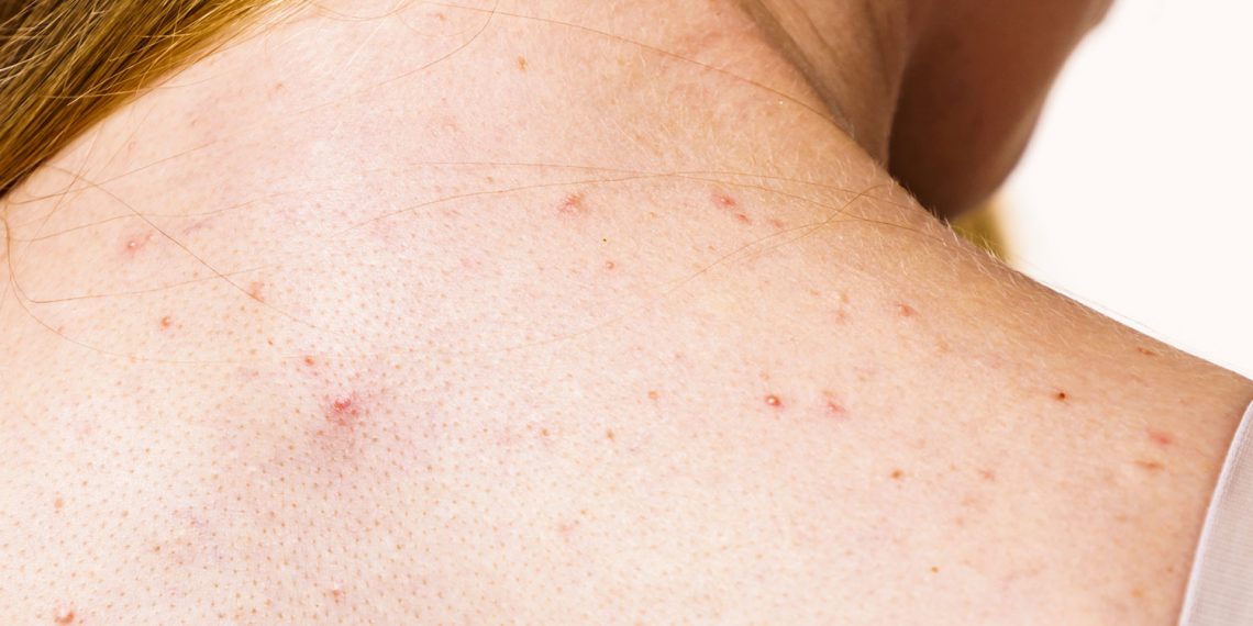 Acné dans le dos : S'en débarrasser une fois pour toutes! 1 - Le Progrès Egyptien