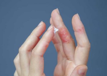 Les traitements les plus efficaces contre l’eczéma 