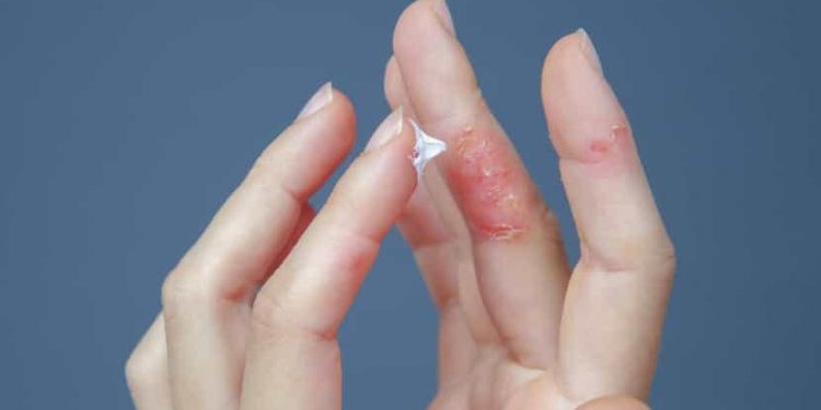 Les traitements les plus efficaces contre l'eczéma 2 - Le Progrès Egyptien Les traitements les plus efficaces contre l'eczéma 1 - Le Progrès Egyptien