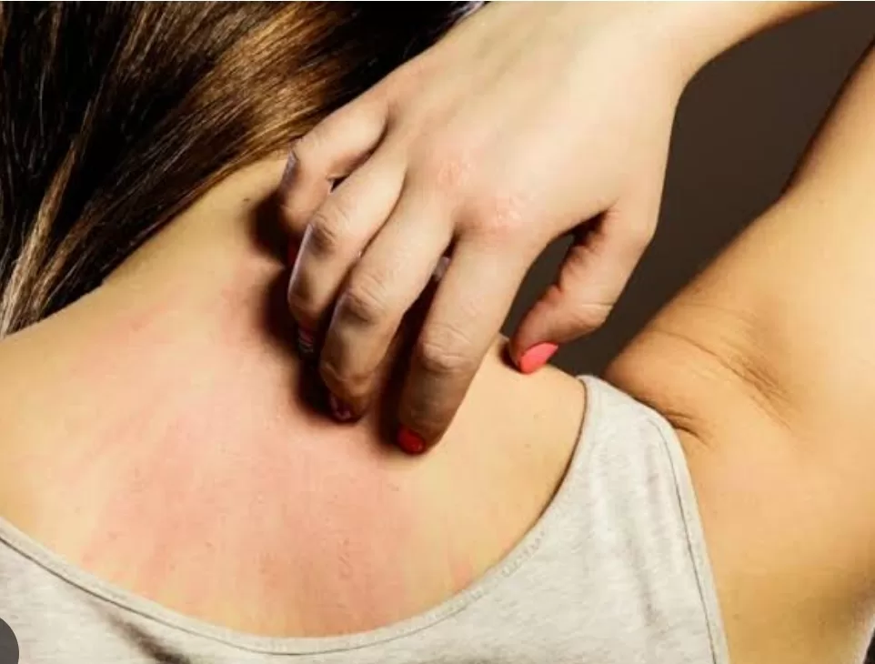 Démangeaisons: Comment apaiser le besoin de se gratter la peau ? 4 - Le Progrès Egyptien Démangeaisons: Comment apaiser le besoin de se gratter la peau ? 3 - Le Progrès Egyptien