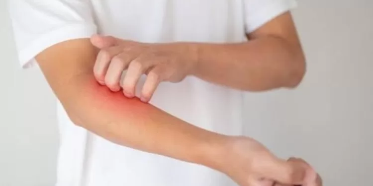 Démangeaisons: Comment apaiser le besoin de se gratter la peau ? 2 - Le Progrès Egyptien Démangeaisons: Comment apaiser le besoin de se gratter la peau ? 1 - Le Progrès Egyptien