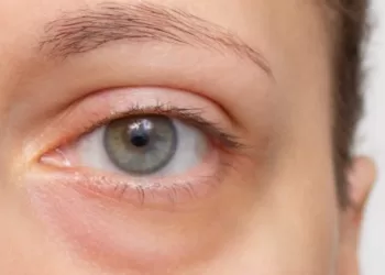 Cernes : Voici ce qu’ils peuvent dire aussi de votre santé