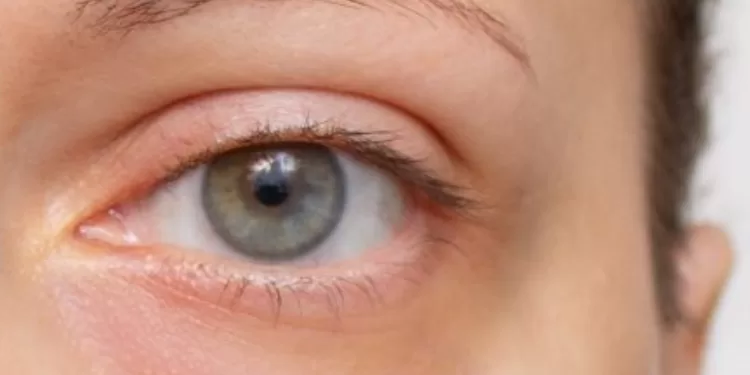 Cernes : Voici ce qu’ils peuvent dire aussi de votre santé 1 - Le Progrès Egyptien