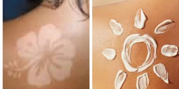 Tan lines, burn lines, Sun Tattoo: Quand TikTok joue avec le feu 2 - Le Progrès Egyptien Tan lines, burn lines, Sun Tattoo: Quand TikTok joue avec le feu 1 - Le Progrès Egyptien
