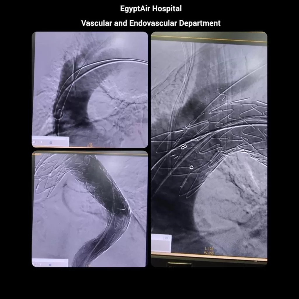 Hôpital EgyptAir: Une chirurgie de haute précision réussie sur un patient de 81 ans 7 - Le Progrès Egyptien