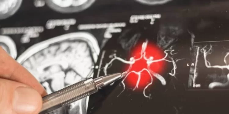 Alzheimer: Découverte d'un mécanisme inédit pour freiner la maladie 1 - Le Progrès Egyptien